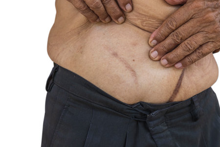 Close up of Scar caused by abdominal aorta surgery in elderly men. Cyanotic keloid Scars caused by...