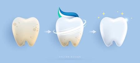 Set of dental cleaning and whitening teeth concept. comparison of clean and dirty tooth. dental health and oral hygiene poster for dentistry. examination teeth, whitening and repair. vector design.のイラスト素材