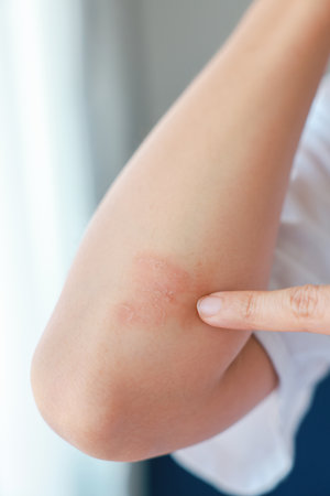 Close-up of skin Asian woman with acute psoriasis on her elbows. autoimmune incurable dermatological...