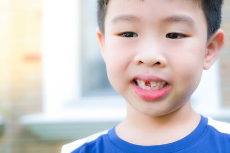 Young  Asia boy (6 years old) happy and fun to lost his top front milk teeth. He opens his mouth and...