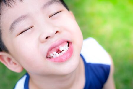 Young  Asia boy (6 years old) happy to lost his top front milk teeth. He looks up his face and standing in the garden under sunlight with copy space. Feeling smile and open his mouth.の写真素材