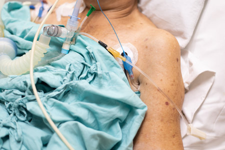 Patient asian elder woman 80s flu covid19 do tracheostomy use ventilator for respiration breathing help on patient bed in intensive care unit (ICU.) room at hospital in concept healthcare in lifeの写真素材