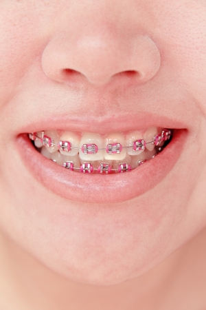 close up of young girl smiling with braces の写真素材