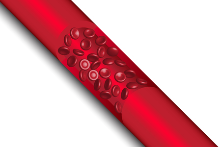 Red blood cells flowing in Atherosclerosis, in human body, illustration, vectorのイラスト素材