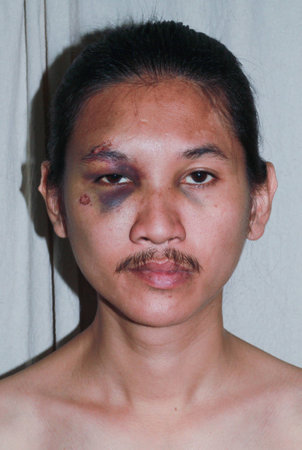 Puffy swollen eye on a Asian man - brow crackの写真素材