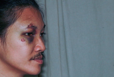 Puffy swollen eye on a Asian man - brow crackの写真素材