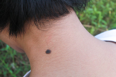 Birthmark on skin,Mole  black Mole closeup neck