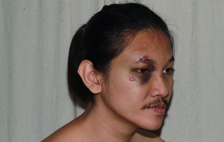 Puffy swollen eye on a Asian man - brow crackの写真素材