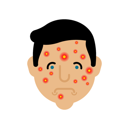 Acne on face man. Pimples on skin maleのイラスト素材