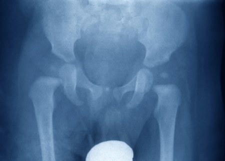 X-Ray of the pelvis and both hips of a little boy, a horizontal picture