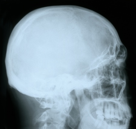 X-ray of a human skull, from profileの写真素材