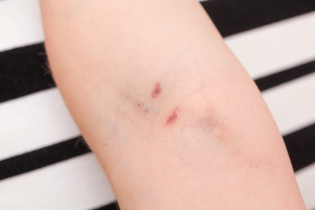 Bruise on the elbow as result of nurse mistake taking the blood with syringe from vein.の写真素材