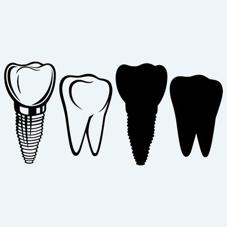 Tooth implant and molar. Isolated on blue backgroundのイラスト素材