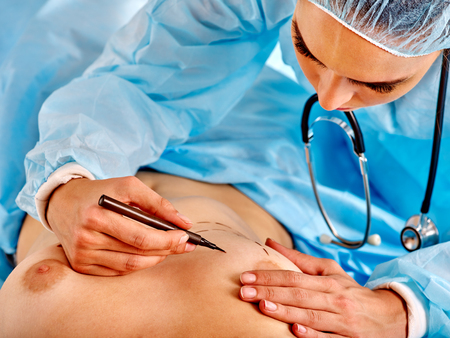 Breast cancer surgery. Doctor makes dotted line on female body. Close up medicine concept.の写真素材