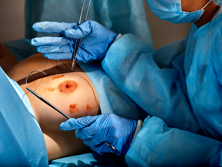 Breast implants in plastic surgery of body part. Surgeon wearing gloves operates womens breasts for augmentation. Doctor holding surgical instruments in clinic for used silicone implant.の写真素材
