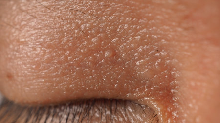 Wart on face. Macro shot of wart near eye. Papilloma on skin around eye nose and neck. Close up of birthmark Papilla or mole on skin. small hard. benign growth on the skin. caused by virus. skincare.の写真素材
