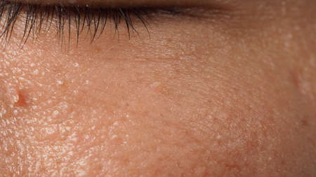 Wart on face. Macro shot of wart near eye. Papilloma on skin around eye nose and neck. Close up of birthmark Papilla or mole on skin. small hard. benign growth on the skin. caused by virus. skincare.の写真素材