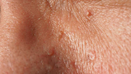 Wart on face. Macro shot of wart near eye. Papilloma on skin around eye nose and neck. Close up of birthmark Papilla or mole on skin. small hard. benign growth on the skin. caused by virus. skincare.の写真素材