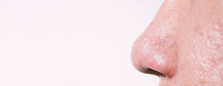 Acne and problem pores. Squeezing blackhead pimple with stainless steel medical acne remover tool. Pressing white and blackhead pimples from nose pores. Acne skin problem closeup. skin care treatment.の写真素材