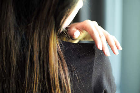 Rear view of woman having the dandruff on the shoulderの写真素材