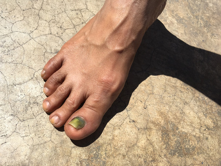 Discolouration of nails after chemotherapy. Side effects from breast cancer treatment.の写真素材