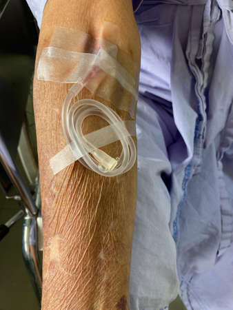 Extension Tube  for peripheral venous cannulation on the arm of an elderly patient