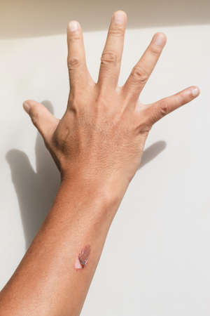 Burns and scalds - Superficial Second Degree Burn, Skin burn, Skin Grafting and Donor Siteの写真素材