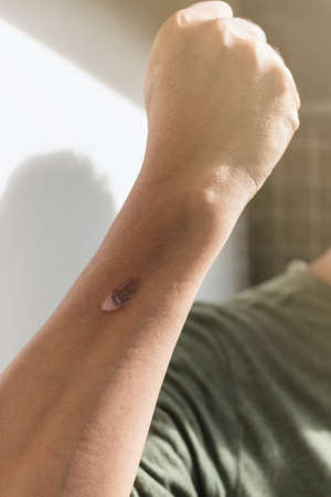 Burns and scalds - Superficial Second Degree Burn, Skin burn, Skin Grafting and Donor Site