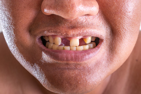 Close-up of young man with a teeth broken.の写真素材