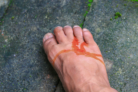 foot wound becomes infected  with  apply medication select focus with shallow depth of field.の写真素材
