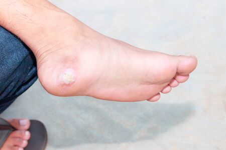 close up pain foot corn isolated on black background with clipping path