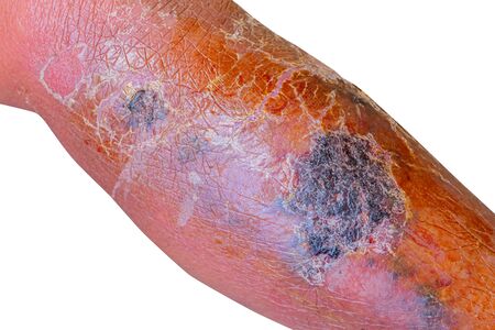 Erysipelas bacterial infection Under the skin leg aged people On  white backgroundの写真素材