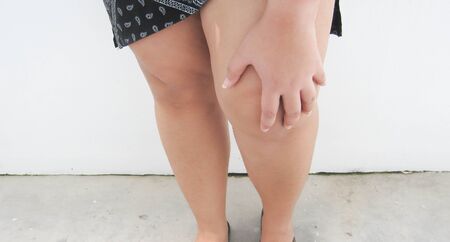 knee pain due to obesity.の写真素材