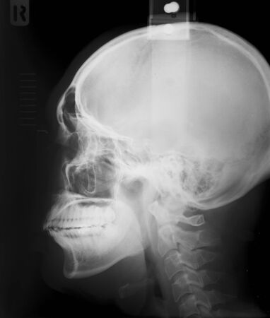 Human head x-ray film 