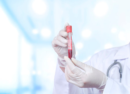 Close up doctor's hand in medical gloves holding test tube (vacutainer) with red blood for testing in hematology laboratory at hospitalの写真素材