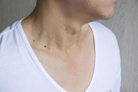 Mole on men's skinの写真素材