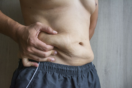 men fat belly fat with stretch marksの写真素材