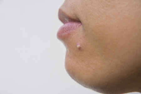 Acne on facial skin close upの写真素材