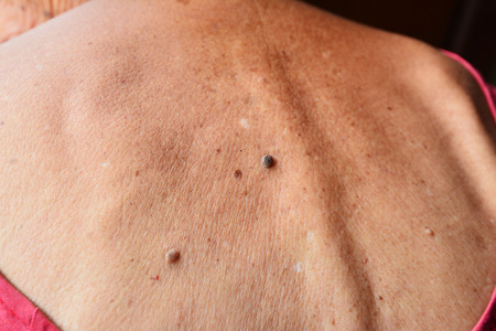 Mole on old woman skin