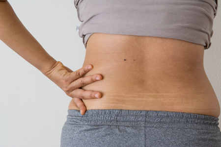 women fat belly fat with stretch marks on white backgroundの写真素材