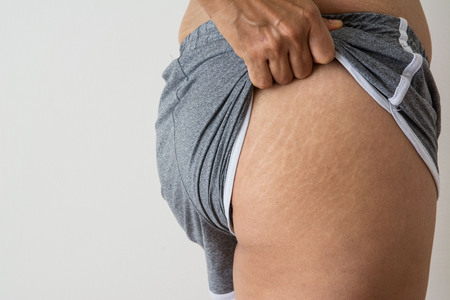 women fat belly fat with stretch marks on white backgroundの写真素材