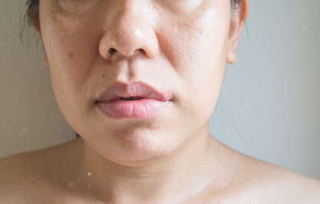 Close up a herpes simplex virus on lips womenの写真素材
