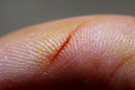 Macro photo of a cut on fingerの写真素材