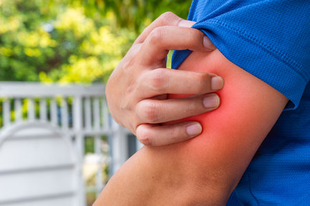 Man scratching red upper armâ€”indicative of eczema, dermatitis, or allergic rash. Skin...