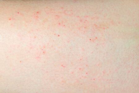 Close up of allergic rash also called eczema or atopic dermatitis.の写真素材