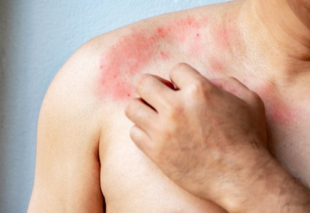 Close up Hand of a man scratching with itchy skin on the body on the chest or shoulde, itching due...