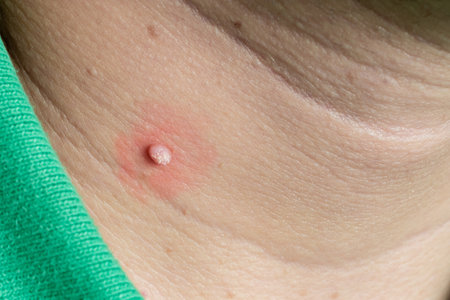 Large mole, Oncology mole big wart on neck skin, Concept dermatology body diseases malignant tumor, Adult man with moles on his neck, Large wart on the man neck, Cosmetic defect in human skin,の写真素材