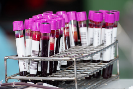 Close up of blood samples in test tubes with purple caps arranged in a metal rack at a laboratory. Medical analysis and health testing concept for diagnosis, research, and clinical examination.の写真素材