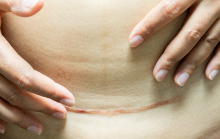 Close-up of a healed C-section scar on a woman's belly with a hand gently touching the skin. Concept...