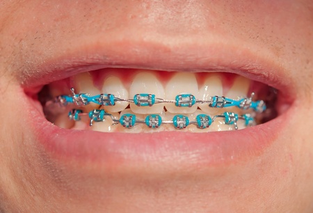 Close-up of a happy teenage boyl smiling with bracesの写真素材